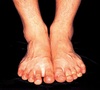 손·발 ‘골칫거리’ 무좀, 전문적인 치료가 중요
