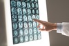 정신질환의 예후, 뇌 MRI 영상으로 예측 가능