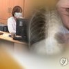 잠복 결핵, 치료받으면 결핵 예방 효과 83%…
