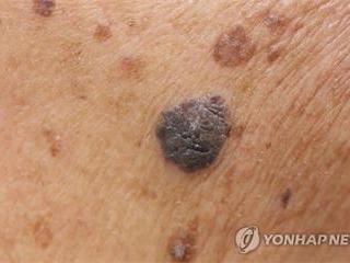 혈압약 티아지드, 피부암과 연관 있나?