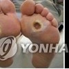 '당뇨발', 지방 줄기세포로 치료 성공